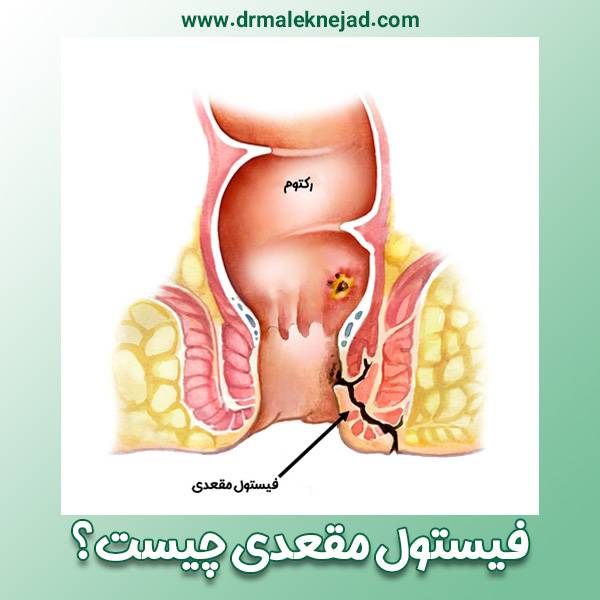 فیستول چیست - https://drmaleknejad.com/