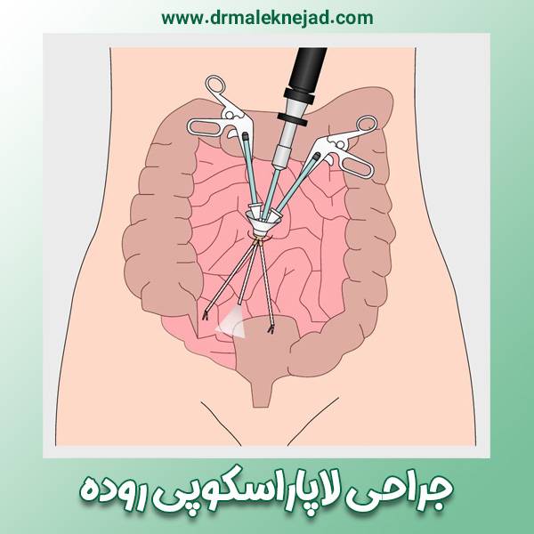 جراحی لاپاراسکوپی روده - https://drmaleknejad.com/