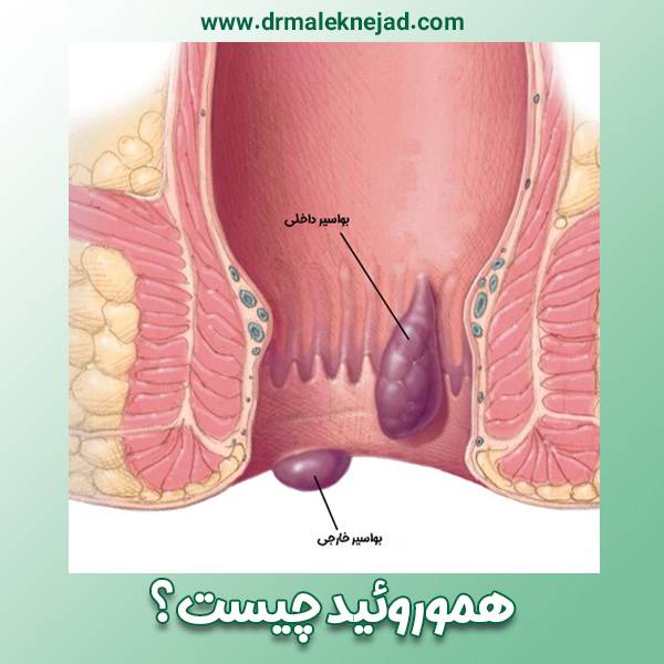 هموروئید - https://drmaleknejad.com/