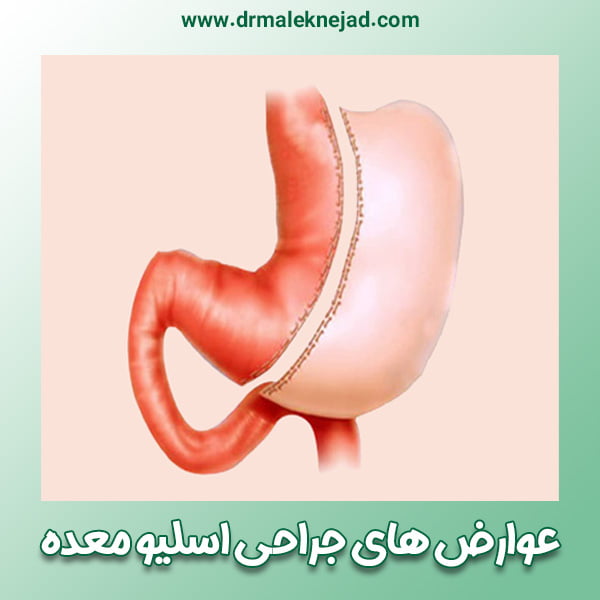 عوارض های جراحی اسلیو معده - https://drmaleknejad.com/
