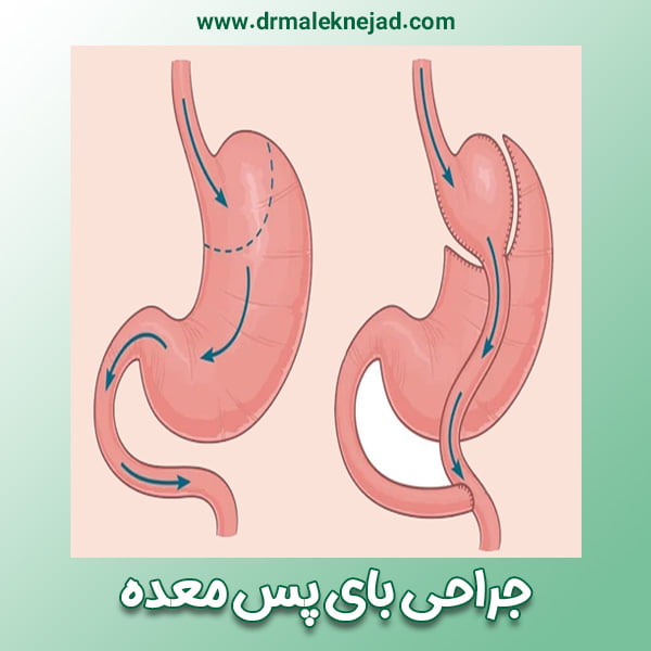 جراحی بای پس معده - https://drmaleknejad.com/