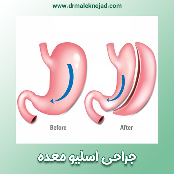 جراحی اسلیو معده - https://drmaleknejad.com/