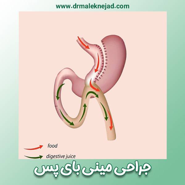 جراحی مینی بای پس - https://drmaleknejad.com/