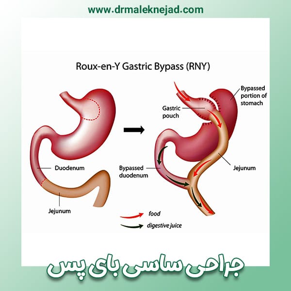 جراحی ساسی بای پس
