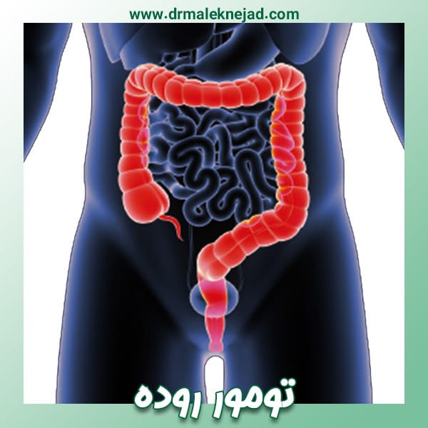تومور روده
