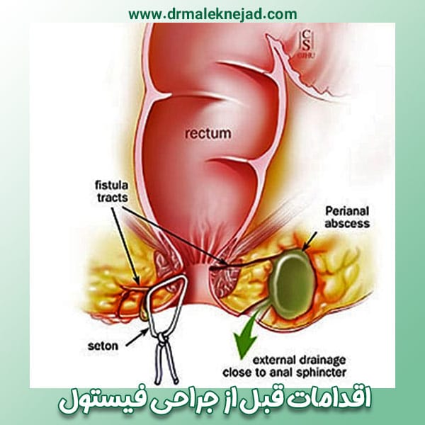 اقدامات قبل از جراحی فیستول