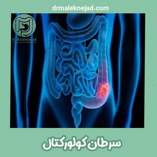 سرطان کولورکتال - دکتر عبدالباسط ملک نژاد
