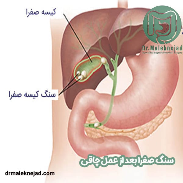 سنگ صفرا بعد از جراحی چاقی - دکتر عبدالباسط ملک نژاد