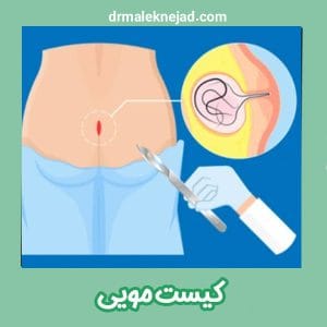 کیست مویی - دکتر عبدالباسط ملک نژاد -drmaleknejad.com