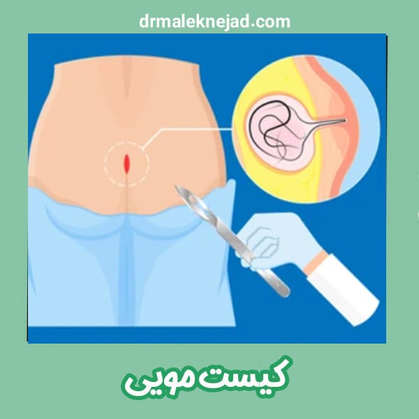 کیست مویی - دکتر عبدالباسط ملک نژاد