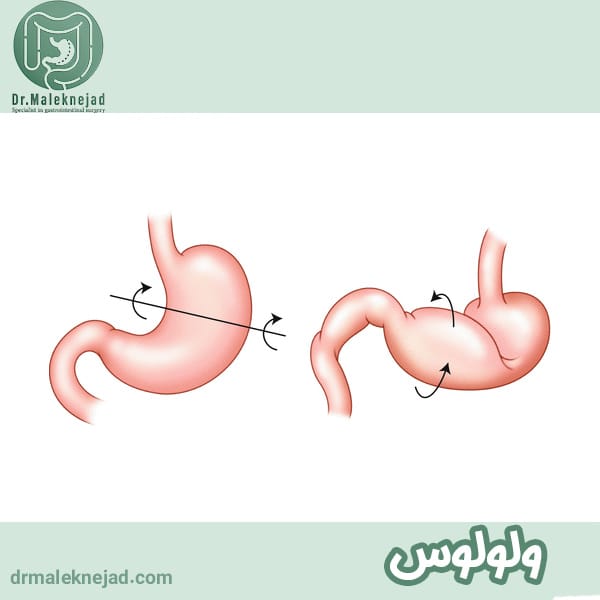 ولولوس معده - دکتر عبدالباسط ملک نژاد