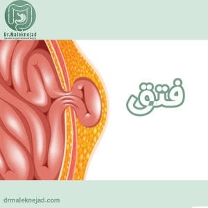 فتق - دکتر عبدالباسط ملک نژاد - drmaleknejad.com