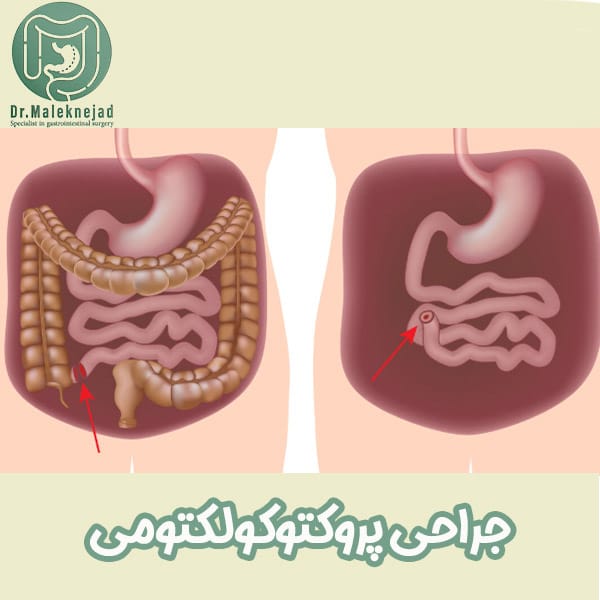 جراحی پروکتوکولکتومی - دکتر عبدالباسط ملک نژاد