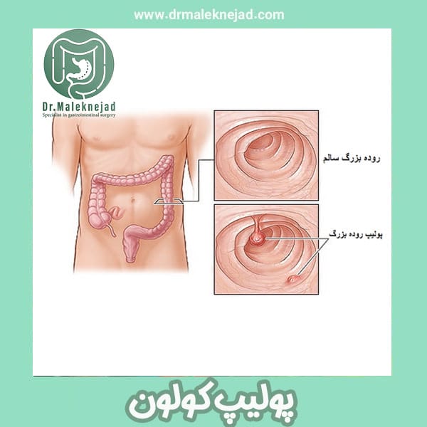 پولیپ کولون -دکتر عبدالباسط ملک نژاد -drmaleknejad.com