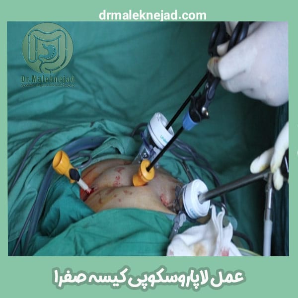 جراحی کیسه صفرا - دکتر ملک نژاد - drmaleknejad.com