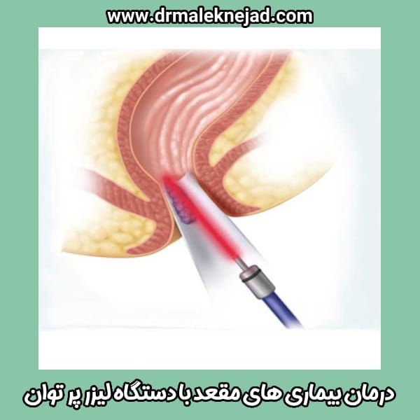 درمان بیماری‌ های مقعد با لیزر پر توان - دکتر عبالباسط ملک نژاد - drmaleknejad.com