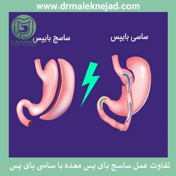 ساسج بای پس معده