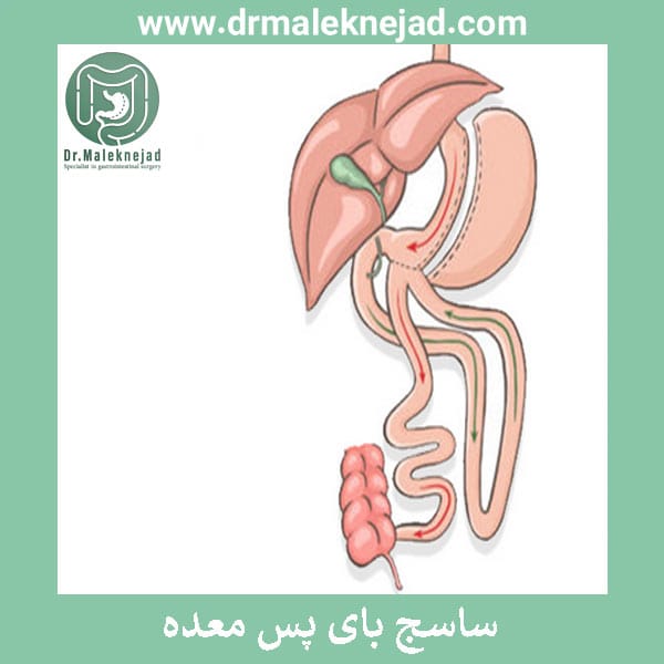 ساسج بای پس معده
